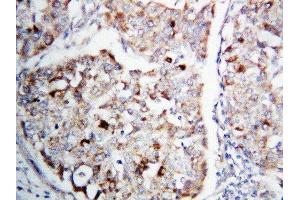 Anti-MEK1 antibody, IHC(P) IHC(P): Human Lung Cancer Tissue
