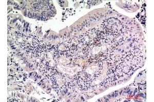 Immunohistochemistry (IHC) analysis of paraffin-embedded Human Colon Cancer, antibody was diluted at 1:100. (FGF2 antibody  (Internal Region))