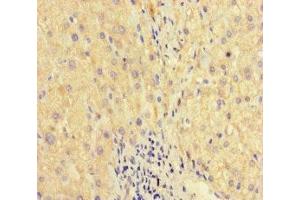 Immunohistochemistry of paraffin-embedded human liver cancer using ABIN7175867 at dilution of 1:100 (WAC antibody  (AA 10-102))