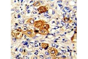 IHC analysis of FFPE human breast carcinoma with C5 antibody (C5 antibody  (AA 253-281))