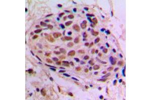 Immunohistochemical analysis of CREB staining in human breast cancer formalin fixed paraffin embedded tissue section. (CREB1 antibody  (Center))