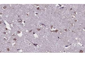 ABIN6274658 at 1/100 staining Human brain cancer tissue by IHC-P.