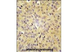 Formalin-fixed and paraffin-embedded human prostata carcinoma tissue reacted with LARS antibody (C-term) (ABIN391611 and ABIN2841532) , which was peroxidase-conjugated to the secondary antibody, followed by DAB staining. (LARS antibody  (C-Term))