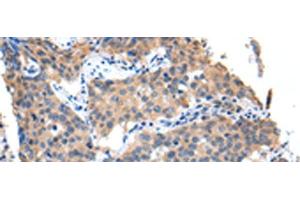 Immunohistochemistry of paraffin-embedded Human lung cancer tissue using PPBP Polyclonal Antibody at dilution of 1:35(x200) (CXCL7 antibody)