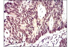 Immunohistochemical analysis of paraffin-embedded rectum cancer tissues using ID2 mouse mAb with DAB staining. (Id2 antibody  (AA 1-134))