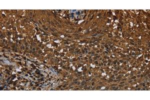 Immunohistochemistry of paraffin-embedded Human cervical cancer tissue using MYBBP1A Polyclonal Antibody at dilution 1:40 (MYBBP1A antibody)