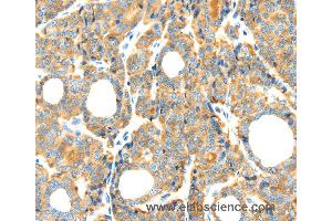 Immunohistochemistry of Human esophagus cancer using RIPK4 Polyclonal Antibody at dilution of 1:40