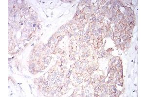 Immunohistochemical analysis of paraffin-embedded ovarian cancer tissues using SK2 mouse mAb with DAB staining.