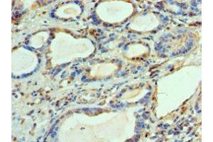 Immunohistochemistry of paraffin-embedded human prostate cancer using ABIN7144450 at dilution of 1:100 (BCL2L14 antibody  (AA 1-327))