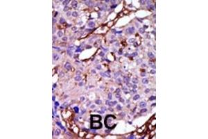 Formalin-fixed and paraffin-embedded human cancer tissue reacted with the primary antibody, which was peroxidase-conjugated to the secondary antibody, followed by DAB staining. (CASK antibody  (C-Term))