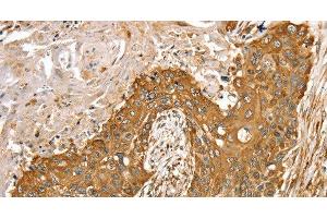 Immunohistochemistry of paraffin-embedded Human esophagus cancer tissue using RASSF9 Polyclonal Antibody at dilution 1:45 (RASSF9 antibody)