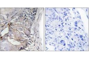 Immunohistochemistry analysis of paraffin-embedded human colon carcinoma, using PDGFR beta (Phospho-Tyr740) Antibody.