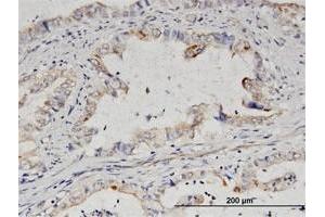Immunoperoxidase of purified MaxPab antibody to IMPA2 on formalin-fixed paraffin-embedded human colon cancer.