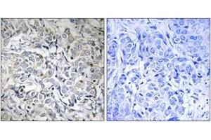 Immunohistochemistry analysis of paraffin-embedded human breast carcinoma, using NF-kappaB p65 (Phospho-Thr505) Antibody. (NF-kB p65 antibody  (pThr505))