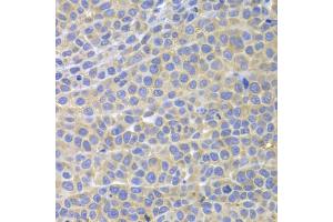 Immunohistochemistry of paraffin-embedded mouse cancer using STAT4 antibody. (STAT4 antibody)