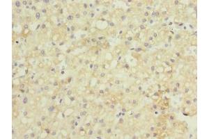 Immunohistochemistry of paraffin-embedded human liver cancer using ABIN7154545 at dilution of 1:100 (GDF2 antibody  (AA 300-429))