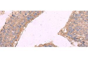 Immunohistochemistry of paraffin-embedded Human liver cancer tissue using KCNN3 Polyclonal Antibody at dilution of 1:40(x200) (KCNN3 antibody)