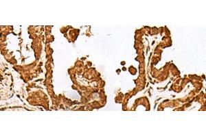 Immunohistochemistry of paraffin-embedded Human thyroid cancer tissue using FAM50A Polyclonal Antibody at dilution of 1:25(x200) (FAM50A antibody)