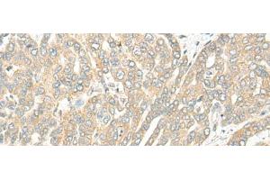 Immunohistochemistry of paraffin-embedded Human liver cancer tissue using ROM1 Polyclonal Antibody at dilution of 1:25(x200) (ROM1 antibody)