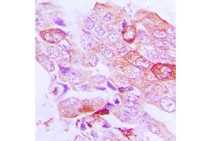 Immunohistochemical analysis of STK33 staining in human lung cancer formalin fixed paraffin embedded tissue section.