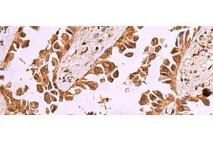 Immunohistochemistry of paraffin-embedded Human lung cancer tissue using IRX1 Polyclonal Antibody at dilution of 1:35(x200)