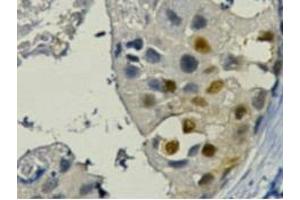 IHC staining of Human breast cancer tissue paraffin-embedded, diluted at 1:200 (PCNA antibody)