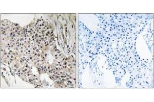 Immunohistochemistry analysis of paraffin-embedded human breast carcinoma tissue, using UEVLD Antibody. (UEVLD antibody  (AA 141-190))