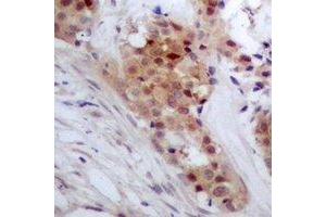 Immunohistochemical analysis of TP53INP2 staining in human breast cancer formalin fixed paraffin embedded tissue section. (TP53INP2 antibody  (C-Term))