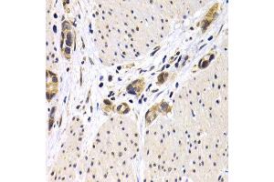 Immunohistochemistry of paraffin-embedded human stomach cancer using ATF2 antibody at dilution of 1:200 (400x lens).