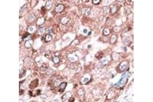 IHC analysis of FFPE hepatocarcinoma cancer tissue stained with the Bak antibody (BAK1 antibody  (AA 56-91))