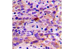 Immunohistochemical analysis of CES2 staining in human breast cancer formalin fixed paraffin embedded tissue section. (CES2 antibody  (Center))