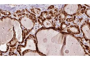 ABIN6267192 at 1/100 staining Human thyroid cancer tissue by IHC-P. (tau antibody  (pSer202))