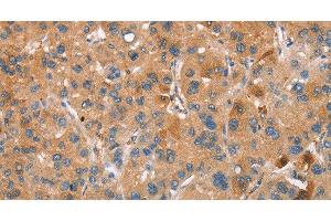 Immunohistochemistry of paraffin-embedded Human liver cancer using PLIN2 Polyclonal Antibody at dilution of 1:30 (ADRP antibody)