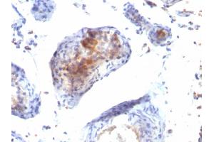 Formalin-fixed, paraffin-embedded human Testicular Carcinoma stained with FOXP3 Monoclonal Antibody (FXP3/197). (FOXP3 antibody)