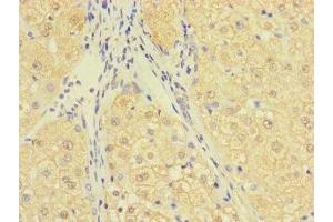Immunohistochemistry of paraffin-embedded human liver cancer using ABIN7174695 at dilution of 1:100 (C1ORF111 antibody  (AA 1-114))