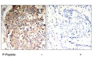 Immunohistochemical analysis of paraffin-embedded human breast carcinoma tissue using PTPN6 (phospho Y536) polyclonal antibody . (SHP1 antibody  (pTyr536))