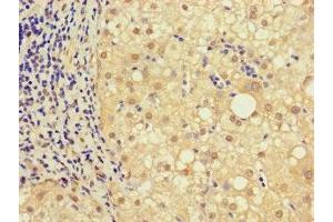 Immunohistochemistry of paraffin-embedded human liver cancer using ABIN7161926 at dilution of 1:100 (NRIP3 antibody  (AA 1-241))
