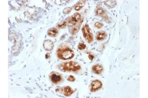 Formalin-fixed, paraffin-embedded human Breast Carcinoma stained with Mammaglobin-Monospecific Mouse Monoclonal Antibody (MGB1/2000). (Mammaglobin A antibody)