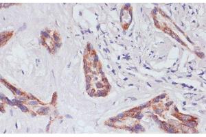 Immunohistochemistry of paraffin-embedded Human liver cancer using RAP1A Polyclonal Antibody at dilution of 1:100 (40x lens). (RAP1A antibody)