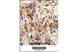 Formalin-fixed and paraffin-embedded human hepatocarcinoma reacted with CYP2J2 Antibody (N-term), which was peroxidase-conjugated to the secondary antibody, followed by DAB staining. (CYP2J2 antibody  (N-Term))