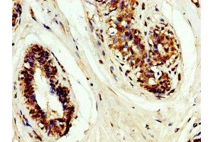 IHC image of ABIN7159489 diluted at 1:200 and staining in paraffin-embedded human breast cancer performed on a Leica BondTM system. (TIMP3 antibody  (AA 1-184))