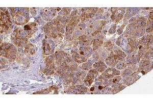 ABIN6273925 at 1/100 staining Human liver cancer tissue by IHC-P. (GNRHR2 antibody)