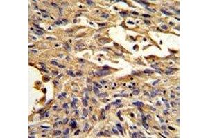 IHC analysis of FFPE human lung carcinoma stained with S100A10 antibody (S100A10 antibody  (AA 12-40))