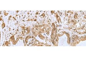Immunohistochemistry of paraffin-embedded Human gastric cancer tissue using PHF6 Polyclonal Antibody at dilution of 1:85(x200) (PHF6 antibody)