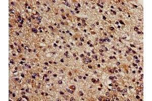 Immunohistochemistry analysis of human glioma using ABIN7148965 at dilution of 1:100 (CBS antibody  (AA 1-413))