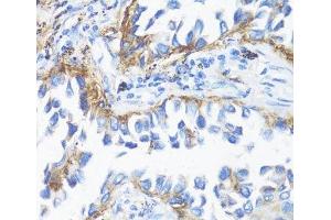 Immunohistochemistry of paraffin-embedded Human lung cancer using HLA-DRB3 Polyclonal Antibody at dilution of 1:100 (40x lens). (HLA-DRB3 antibody)