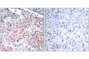 Immunohistochemical analysis of paraffin-embedded human breast carcinoma tissue using Estrogen Receptor-α (phospho-Ser104) antibody (E011070). (Estrogen Receptor alpha antibody  (pSer104))