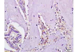 Formalin-fixed and paraffin embedded human colon carcinoma labeled with Rabbit Anti IL-4R/CD124 Plastin Polyclonal Antibody, Unconjugated  at 1:200 followed by conjugation to the secondary antibody and DAB staining (IL4 Receptor antibody  (AA 201-300))