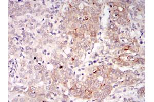 Immunohistochemical analysis of paraffin-embedded human cervical cancer tissues using BLNK monoclonal antibody, clone 5G9  with DAB staining.