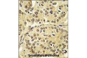 Formalin-fixed and paraffin-embedded human prostata carcinoma tissue reacted with TIEG antibody (N-term) (ABIN392159 and ABIN2841880) , which was peroxidase-conjugated to the secondary antibody, followed by DAB staining. (KLF10/TIEG1 antibody  (N-Term))